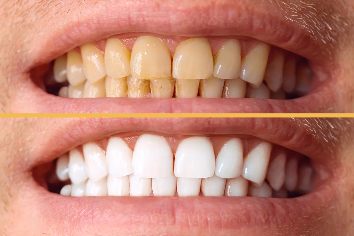 Cómo tener los dientes más blancos Zenit Odontólogos Jerez Manchas Tabaco