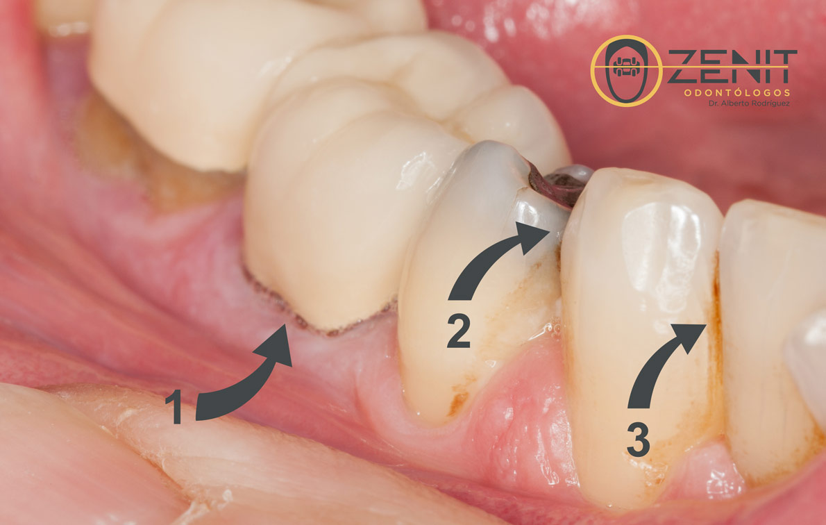 Cómo tener los dientes más blancos Zenit Odontólogos Jerez Manchas Dientes