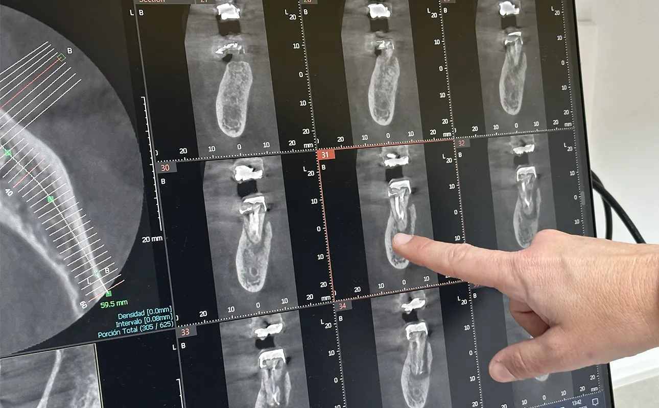 Endodoncia en Jerez de la Frontera, Zenit Odontólogos Dentista Elena Mellado Jerez