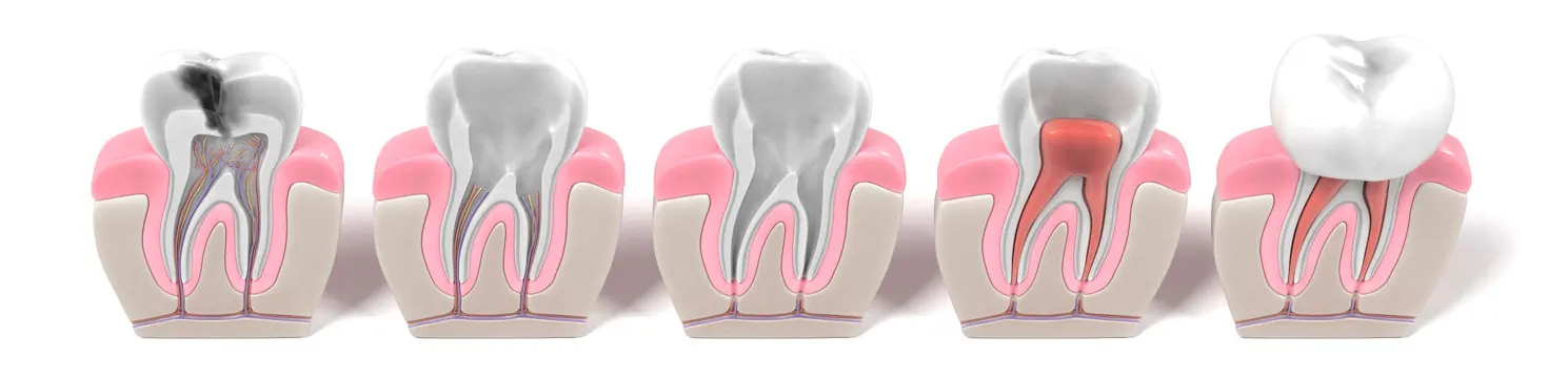 dientes con endodoncia zenit odontologos